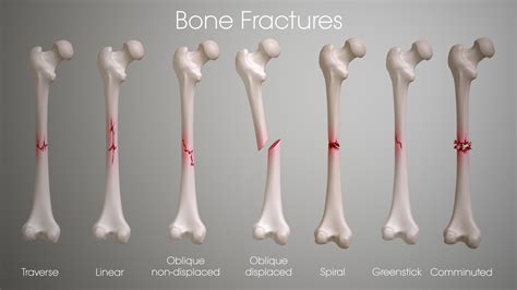 An illustration of bone fracture types, highlighting their causes and effects